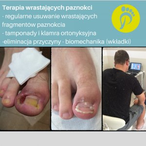 Wrastające paznokcie. Gabinet podologiczny. Justyna Tujko