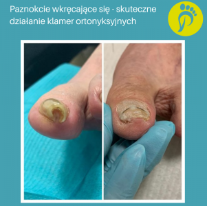 Terapia paznokci wkręcających się. Gabinet podologiczny.