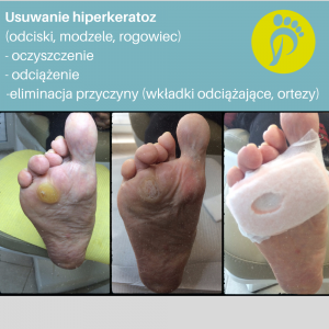 gabinet podologiczny Justyna Tujko - usuwanie zrogowaceń (hiperkeratoz)