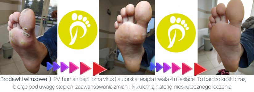 brodawki wirusowe hpv (kurzajki)