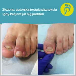 Tym razem stan po chirurgicznym zerwaniu płytki. Paznokieć dużego palca z zatrzymanym wzrostem. Wrastający  paznokieć palca drugiego. Terapia zakończona sukcesem. Gabinet Podologiczny Justyna Tujko